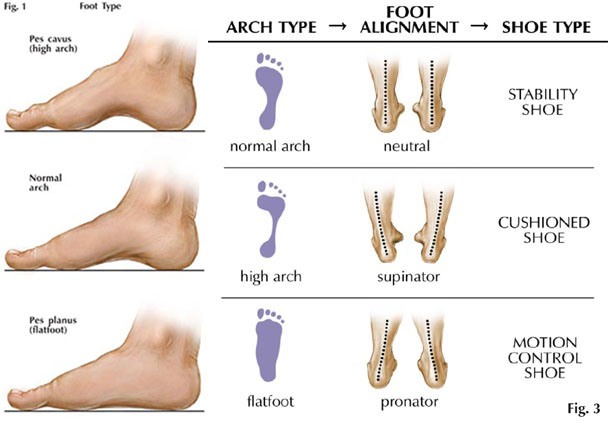 Medscape sales plantar fasciitis